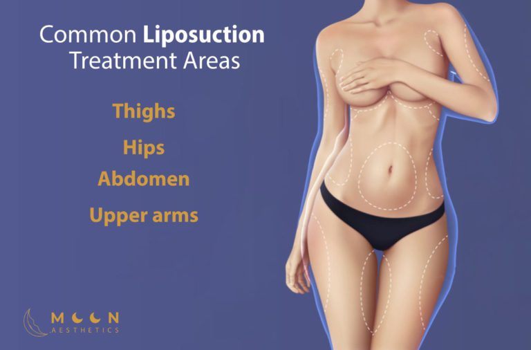 Common Liposuction Treatment Areas