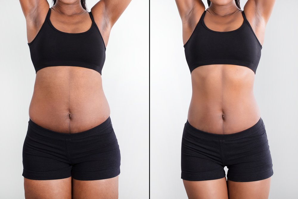 Lipo 360 Before and After Miami 03