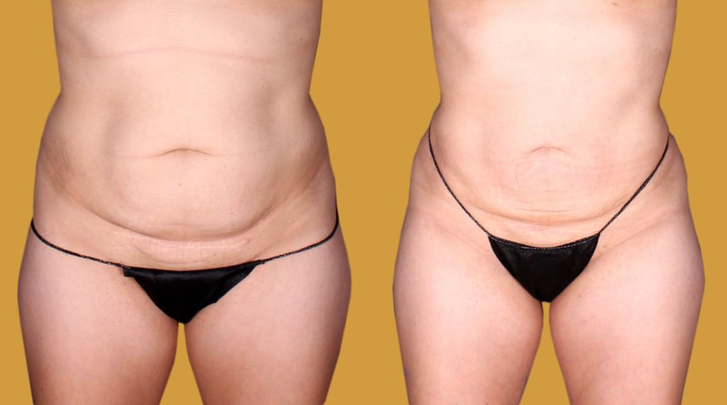 Lipo 360 Before and After Miami