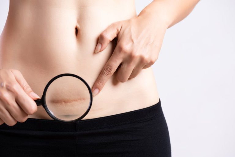 does liposuction leave scars 2