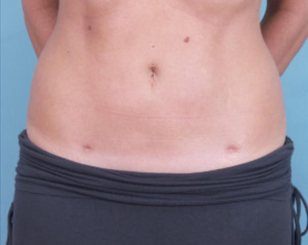 liposuction scar images