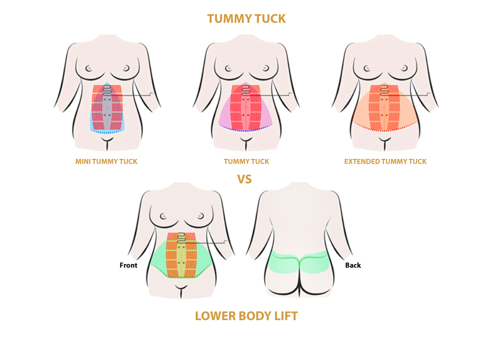 Lower Body Lift vs Tummy Tuck