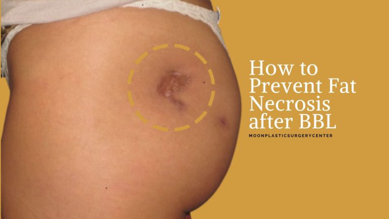 How to Prevent Fat Necrosis after BBL