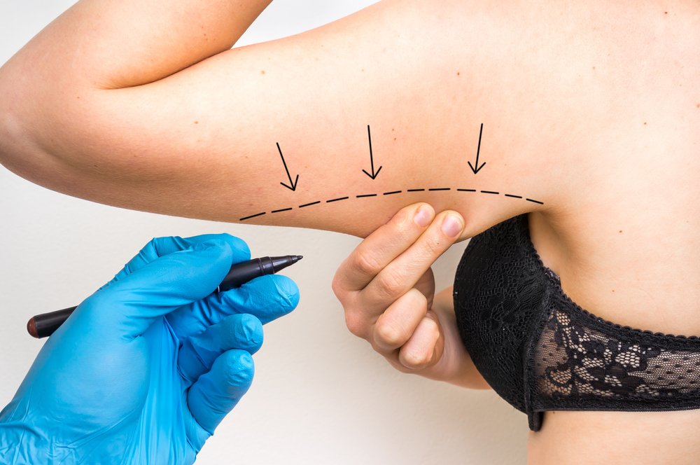 Arm liposuction procedure