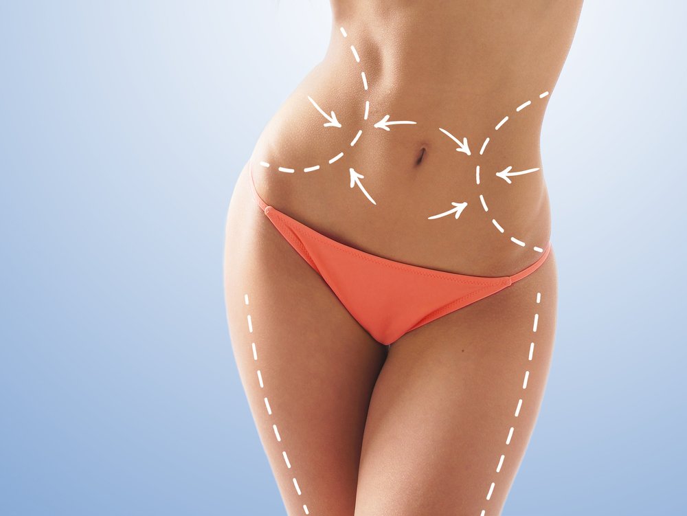 What Is Smart Liposuction