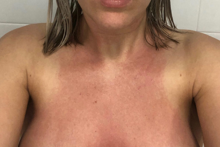 Woman with Rash After Breast Augmentation