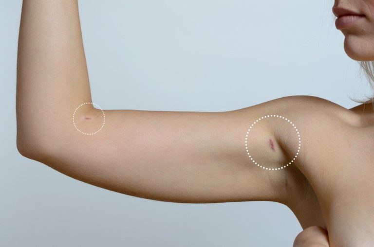 Arm Liposuction Scars image