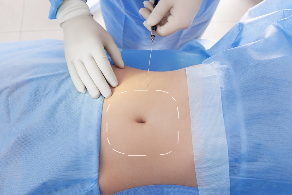 Laser Liposuction Recovery