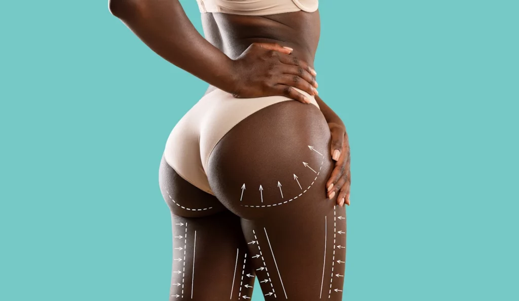 African-American woman in white underwear with marking on her butt and thighs