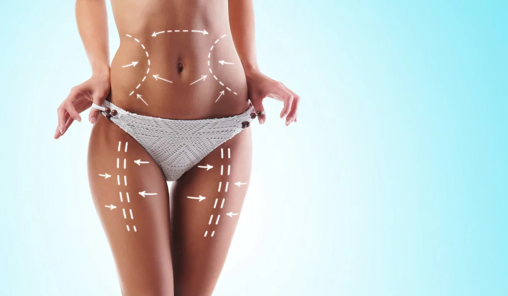 Arrows pointing to the typical liposuction areas on a body