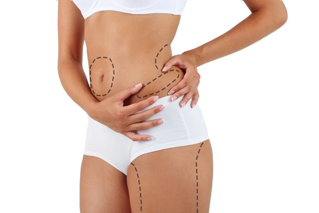 Woman in white underwear with labeled areas for liposuction 