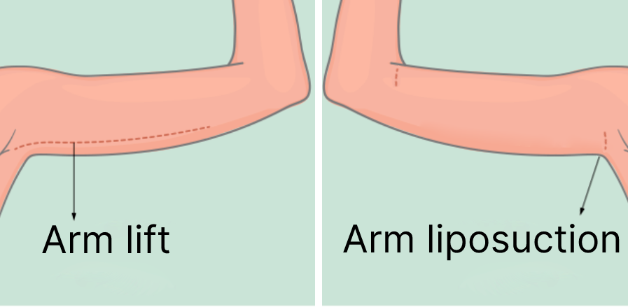 Arm lift vs. Arm liposuction