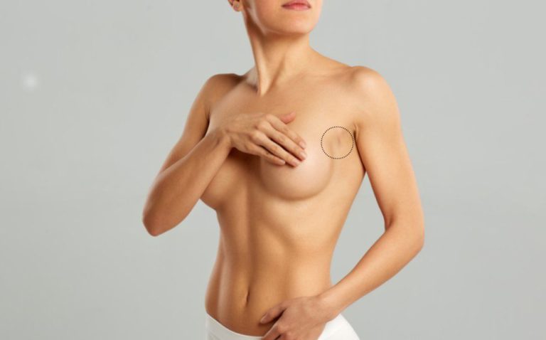 Transaxillary Breast Augmentation Scars