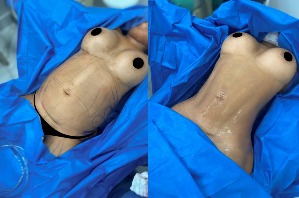 HD Liposuction Before and After