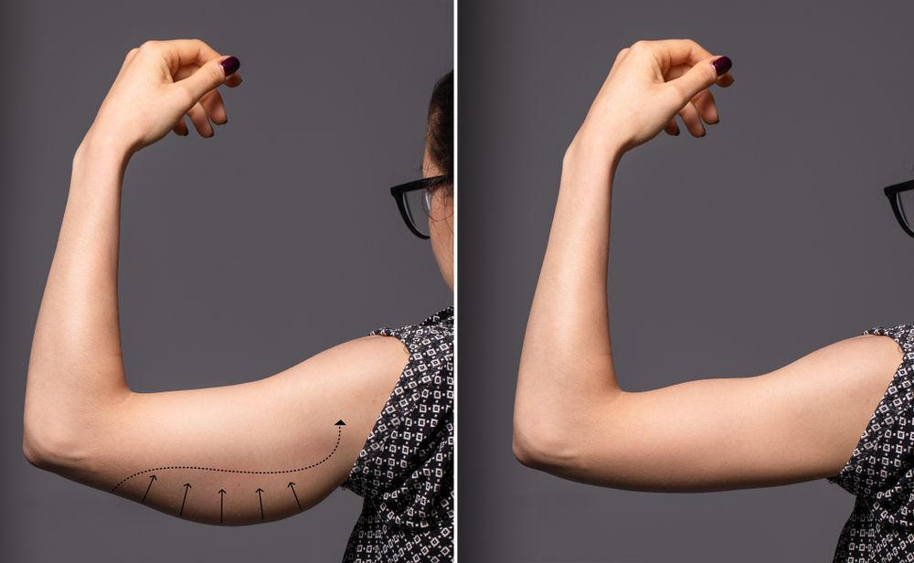 Arm Lift Cost in the US - Before and After