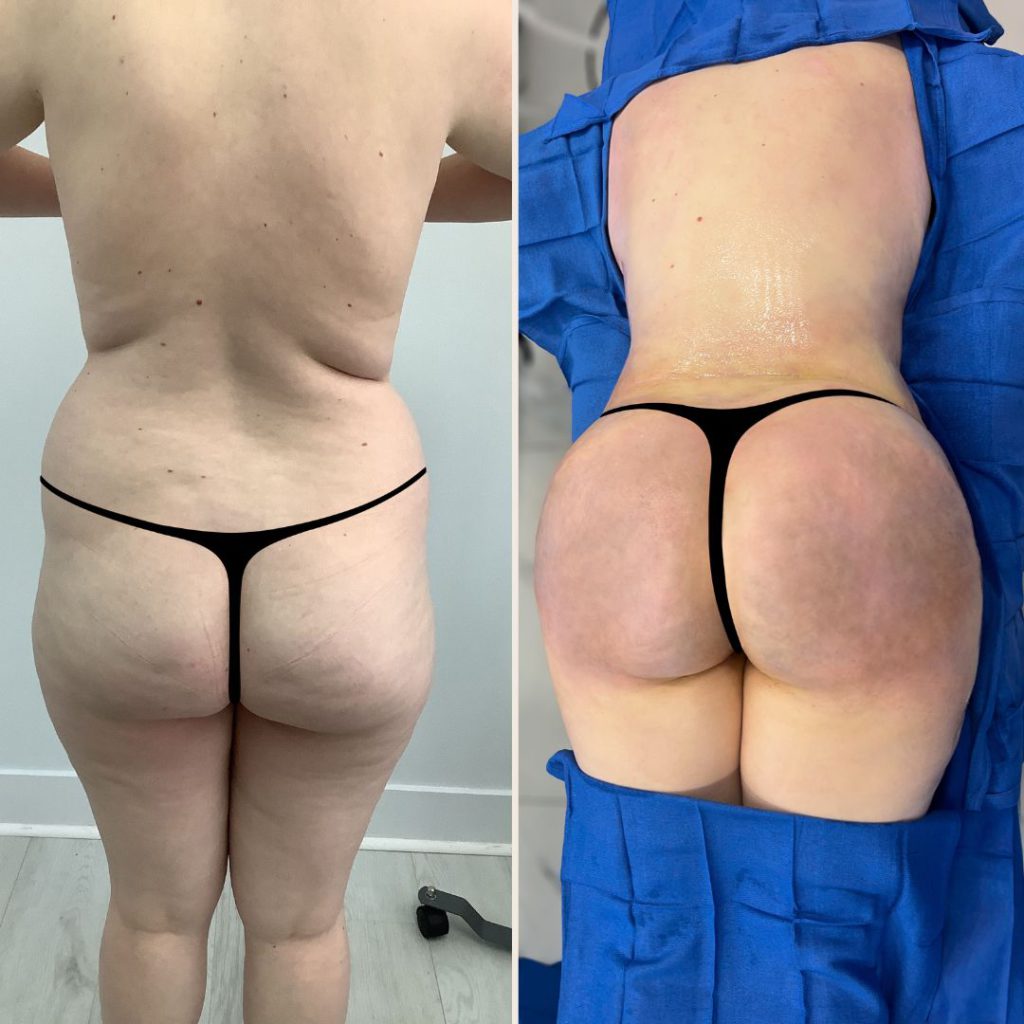 Brazilian Butt Lift Before and After - Case #1