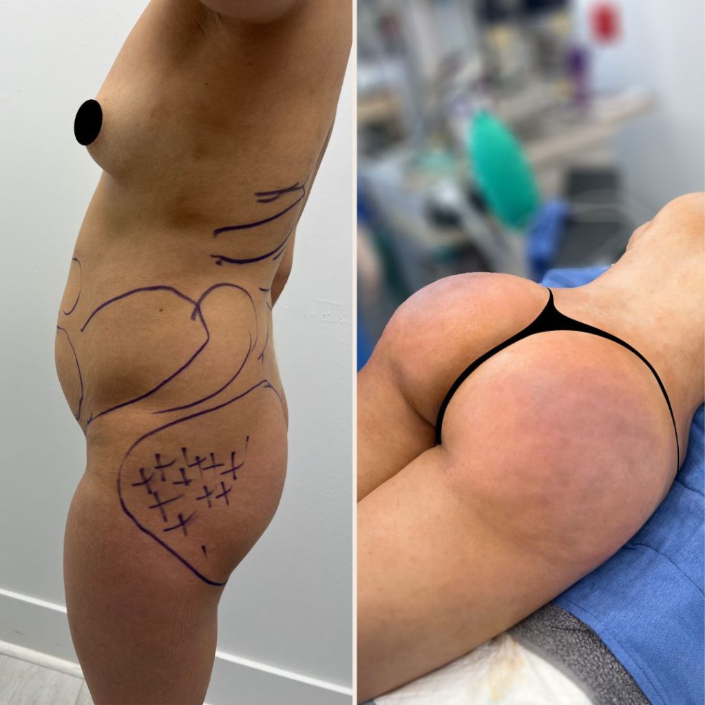 Brazilian Butt Lift Before and After Miami - Case #10