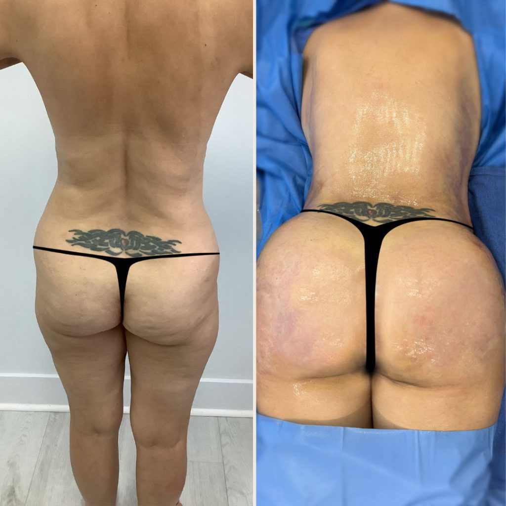 Brazilian Butt Lift Before and After Miami - Case #11
