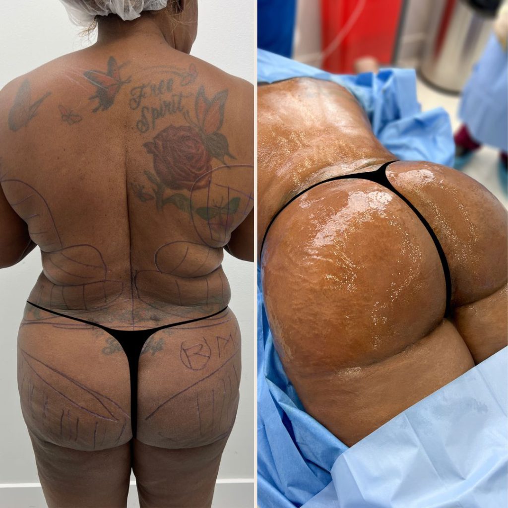 Brazilian Butt Lift Before and After Miami - Case #12