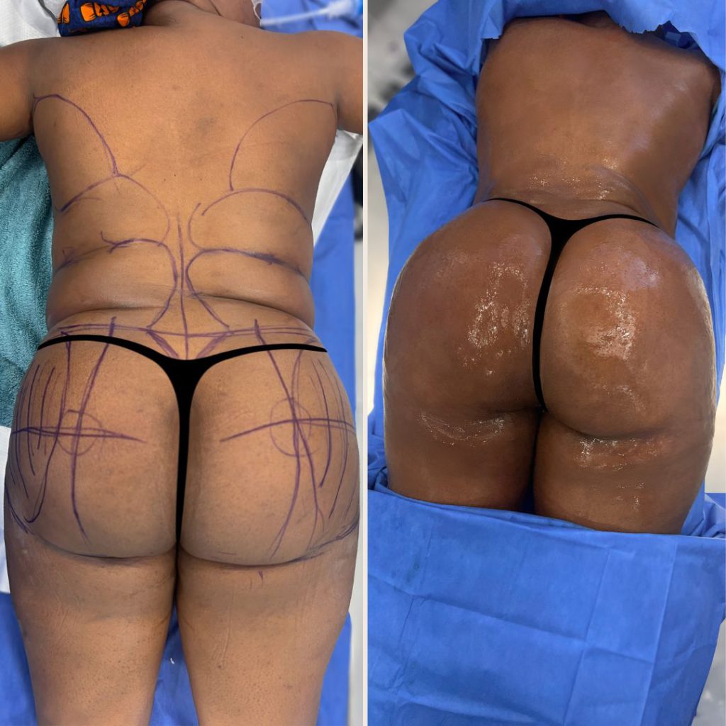 Brazilian Butt Lift Before and After Miami - Case #17