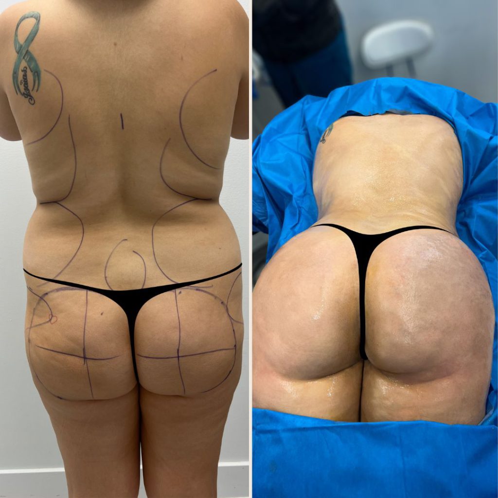 Brazilian Butt Lift Before and After Miami - Case #18