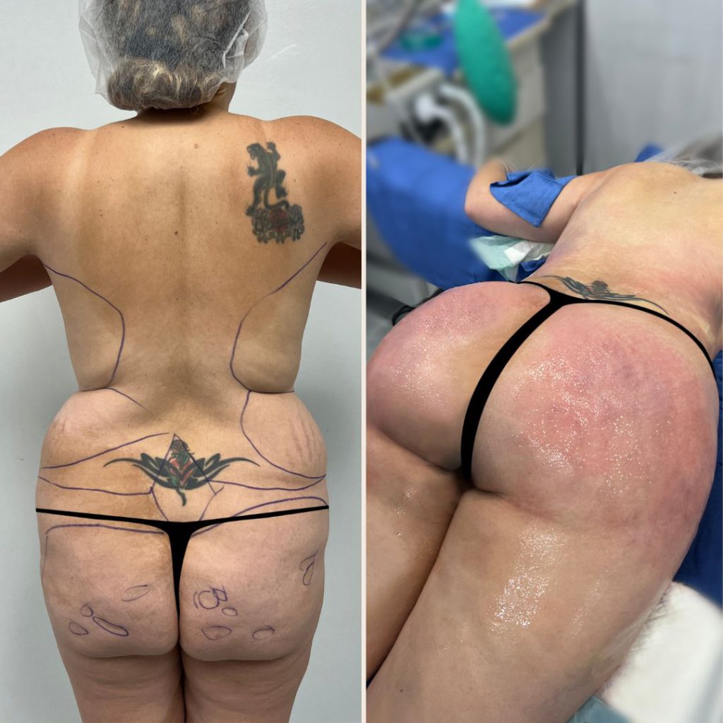 Brazilian Butt Lift Before and After Miami - Case #19