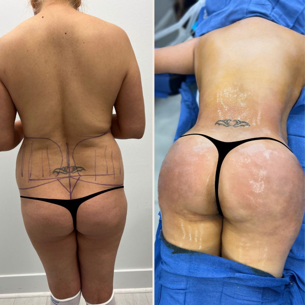 Brazilian Butt Lift Before and After Miami - Case #2