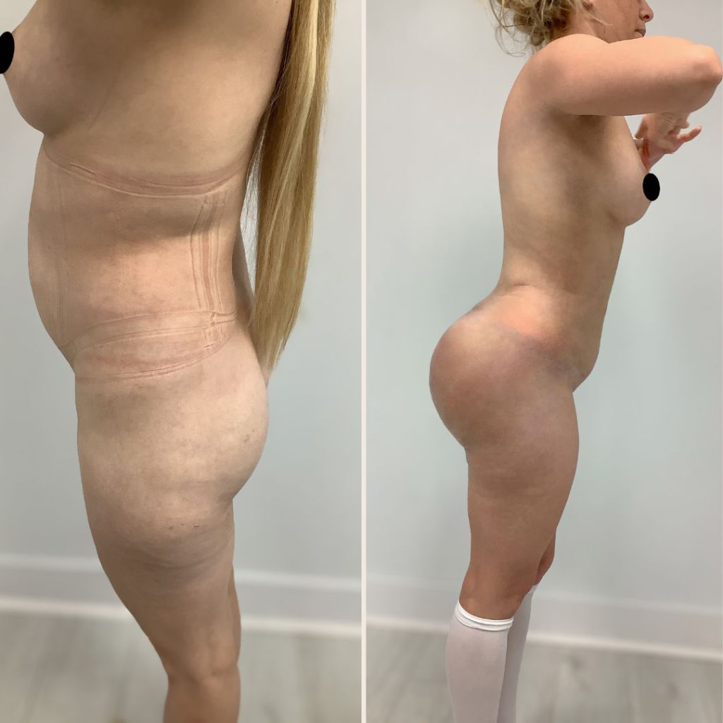 Brazilian Butt Lift Before and After Miami - Case #20