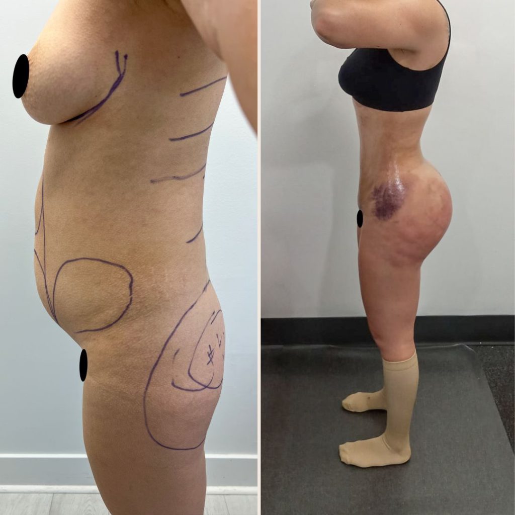 Brazilian Butt Lift Before and After Miami - Case #24
