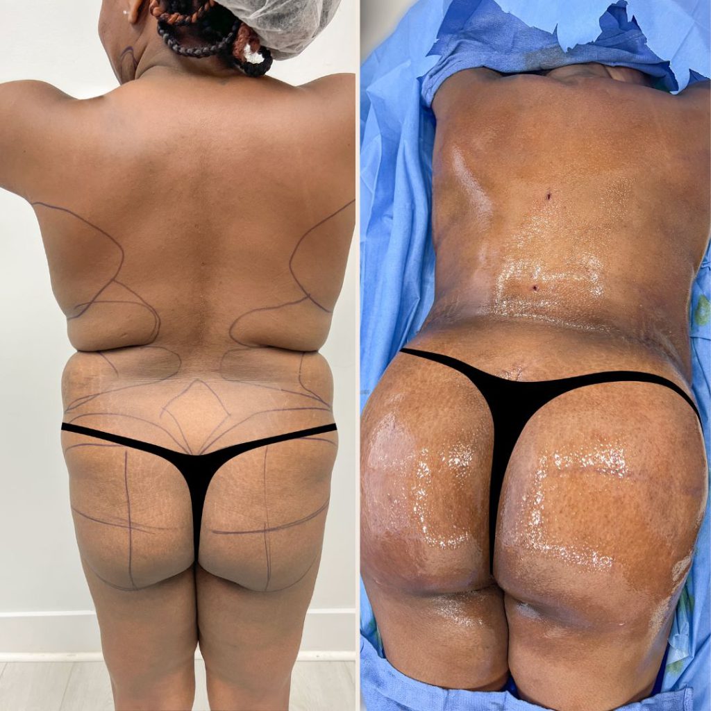 Brazilian Butt Lift Before and After Miami - Case #25