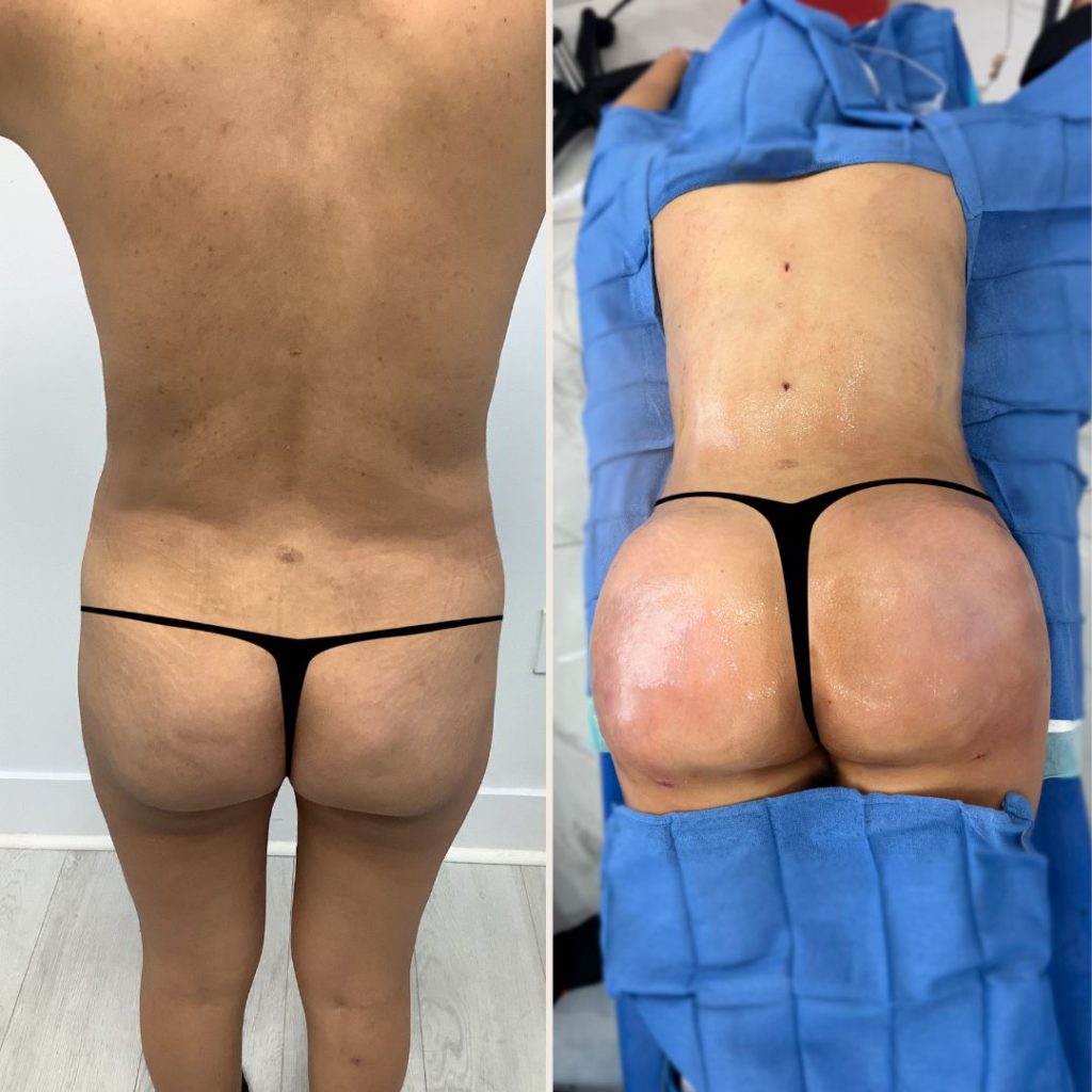 Brazilian Butt Lift Before and After Miami - Case #26