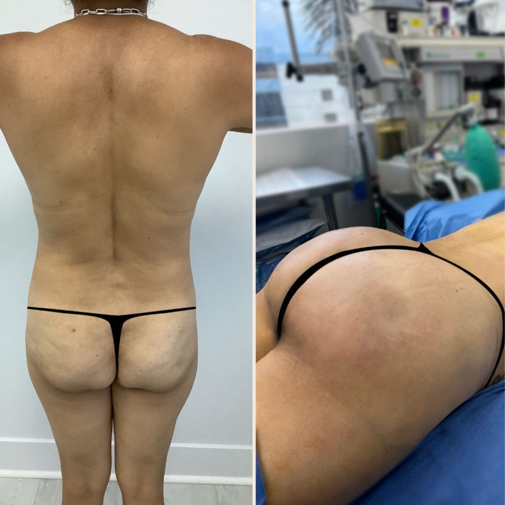 Brazilian Butt Lift Before and After Miami - Case #27