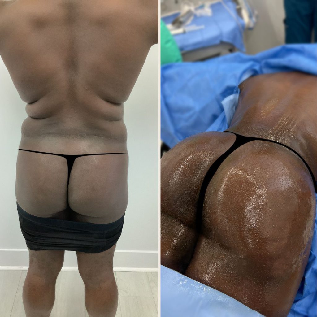 Brazilian Butt Lift Before and After Miami - Case #29