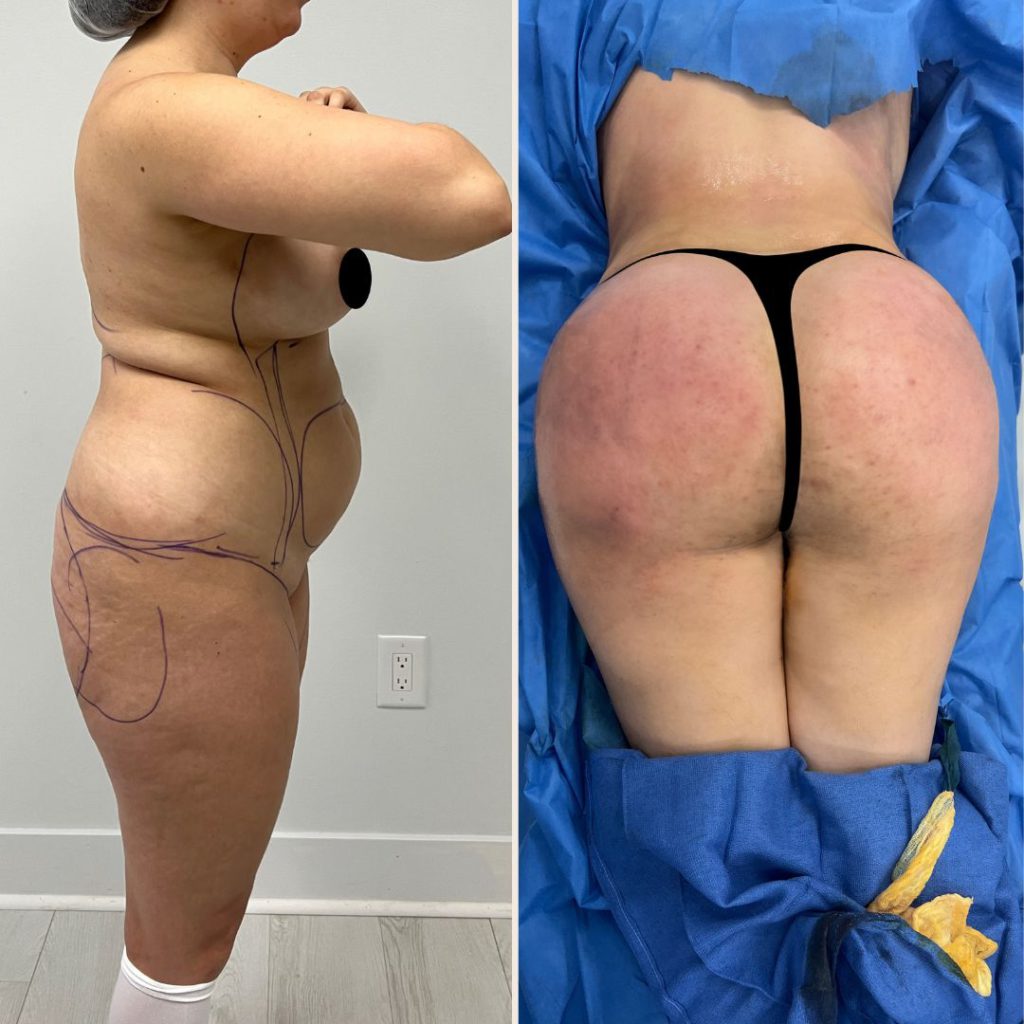 Brazilian Butt Lift Before and After Miami - Case #3