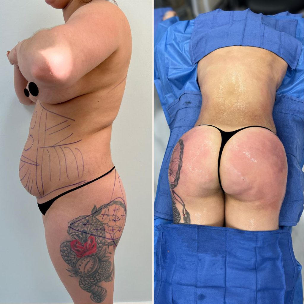 Brazilian Butt Lift Before and After Miami Case 4