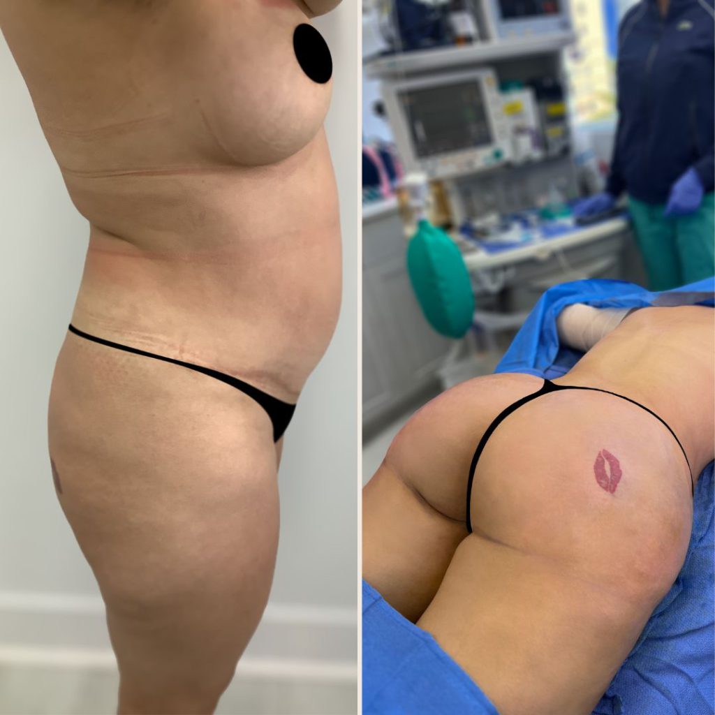 Brazilian Butt Lift Before and After Miami - Case #5
