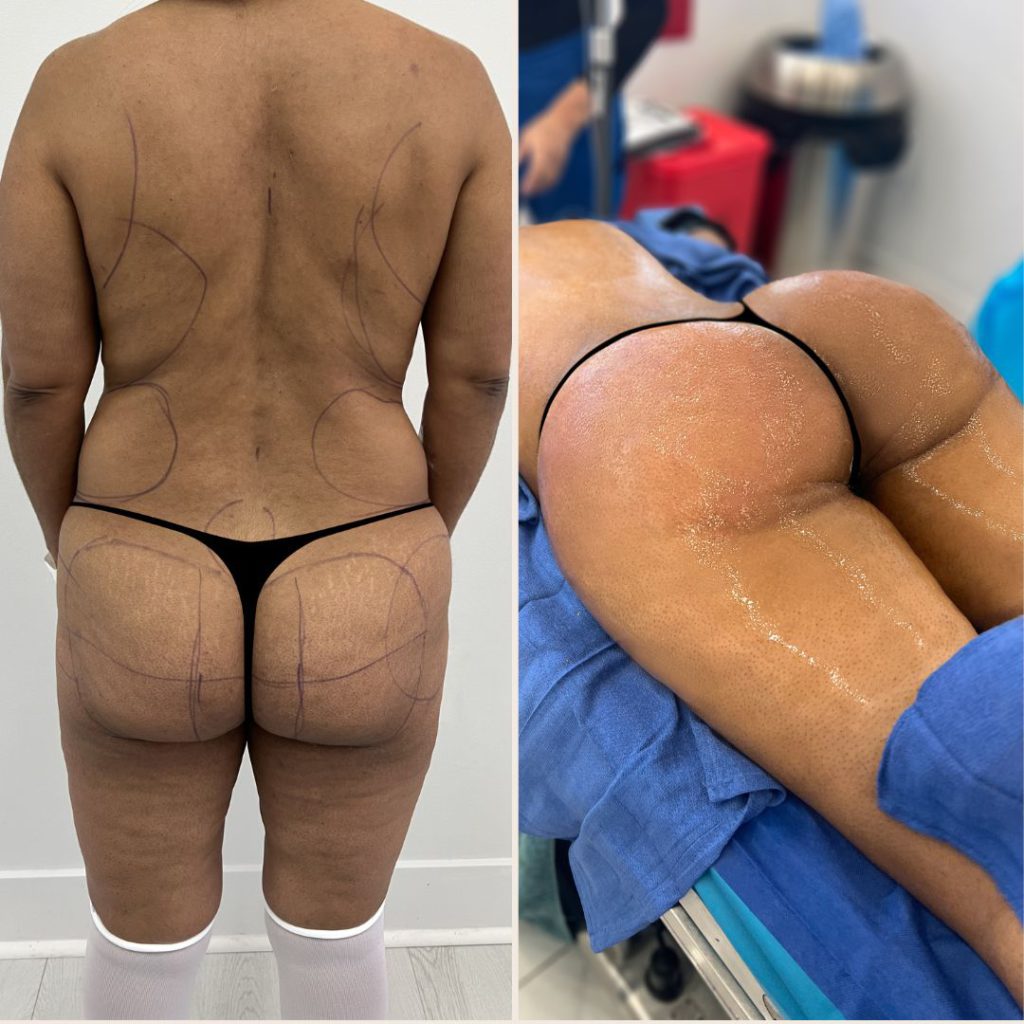 Brazilian Butt Lift Before and After Miami - Case #6