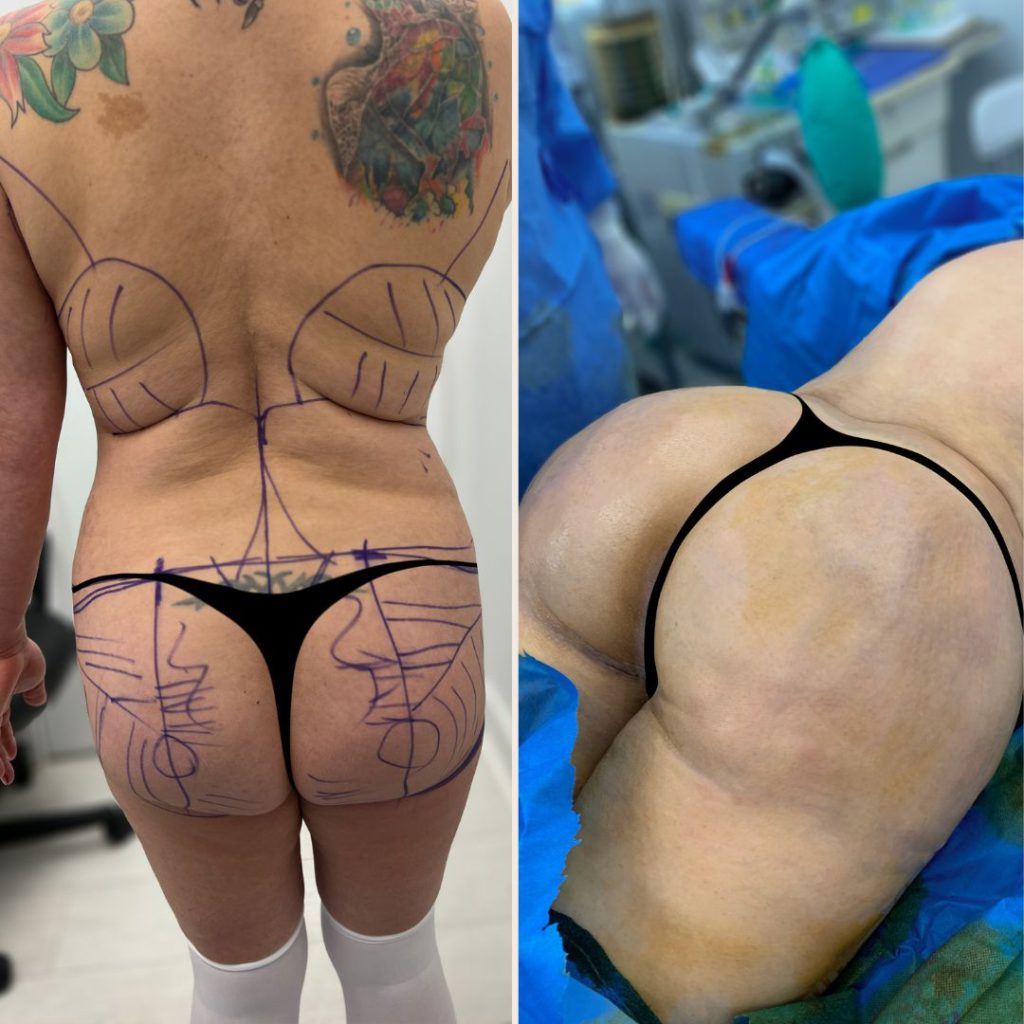 Brazilian Butt Lift Before and After Miami - Case #8