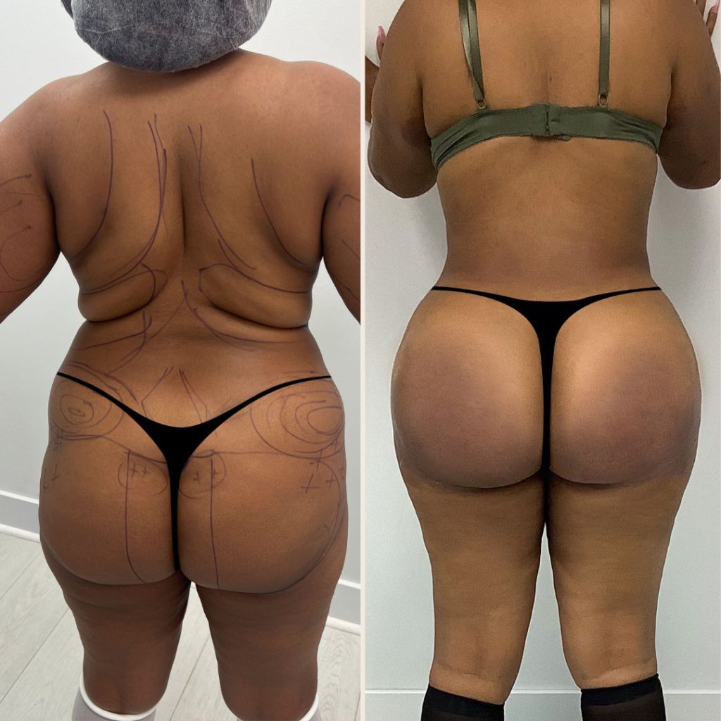 Brazilian Butt Lift Before and After Miami - Case #9