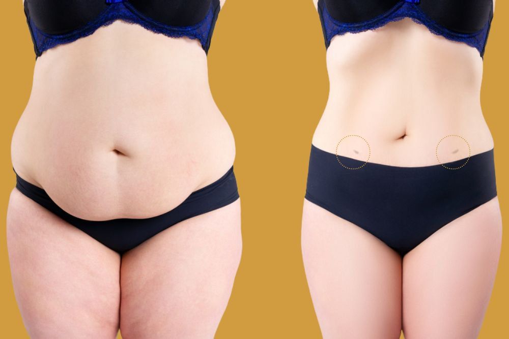 Tumescent Liposuction Scars What to Expect