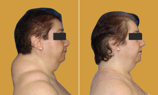 Buffalo Hump Removal at Moon Plastic Surgery in Miami, Priced from